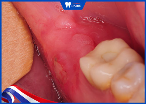 Triệu chứng nhiễm trùng sau lúc nhổ răng số 8