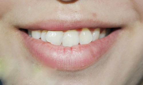 Răng cửa lệch nhân trung khiến cho một hàm răng mất tính hình thể